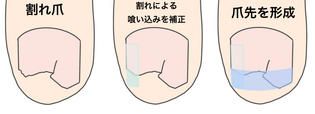 割れ爪の修復