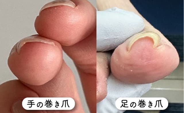 手の巻き爪と足の巻き爪の原因