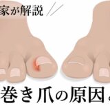 手足の巻き爪の原因は何？巻き爪を防ぐ対策も解説