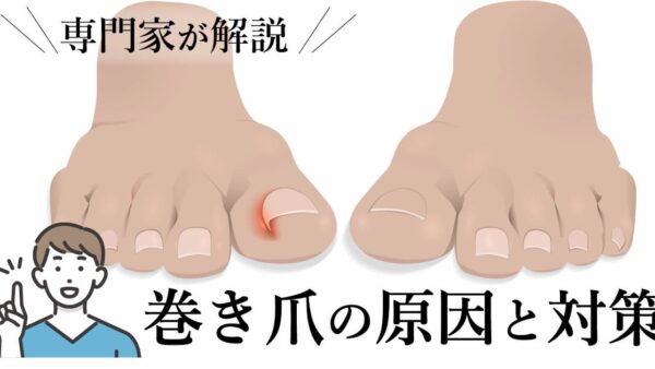 手足の巻き爪の原因は何？巻き爪を防ぐ対策も解説