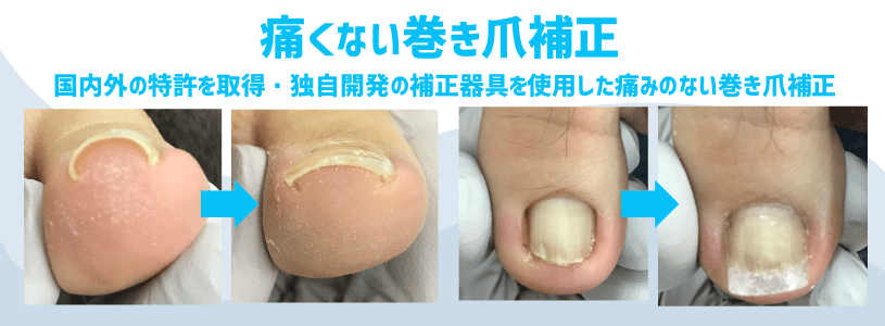 巻き爪改善