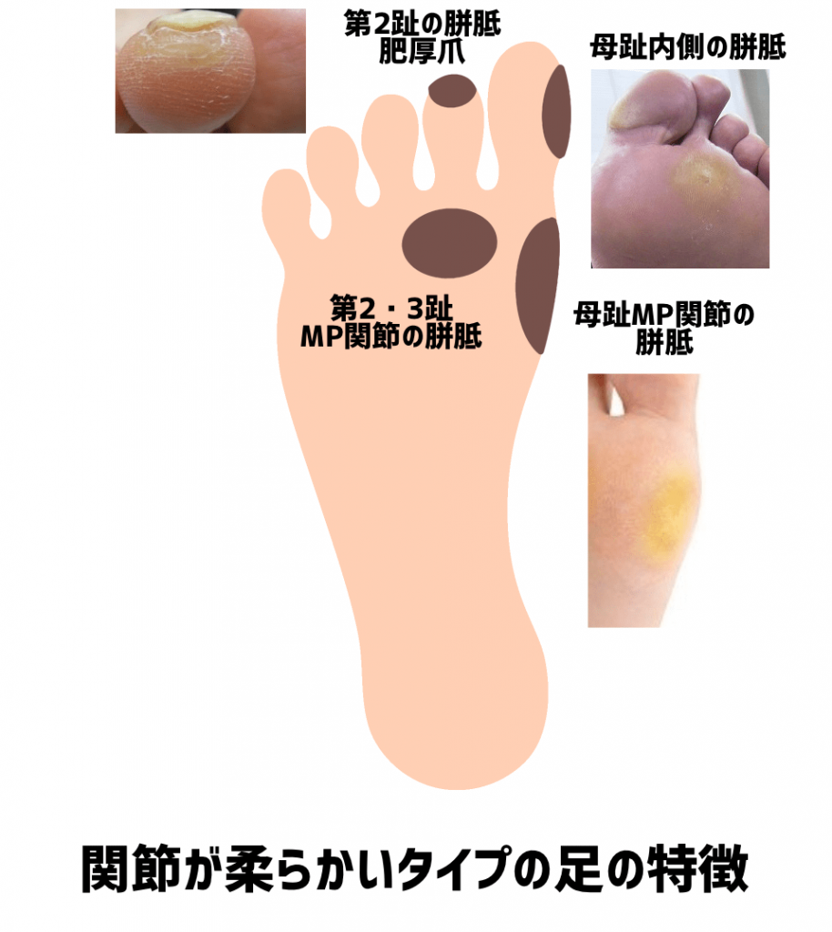 金沢巻き爪 柔らかいタイプ