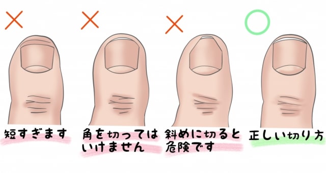 巻き爪予防のための正しい爪の切り方