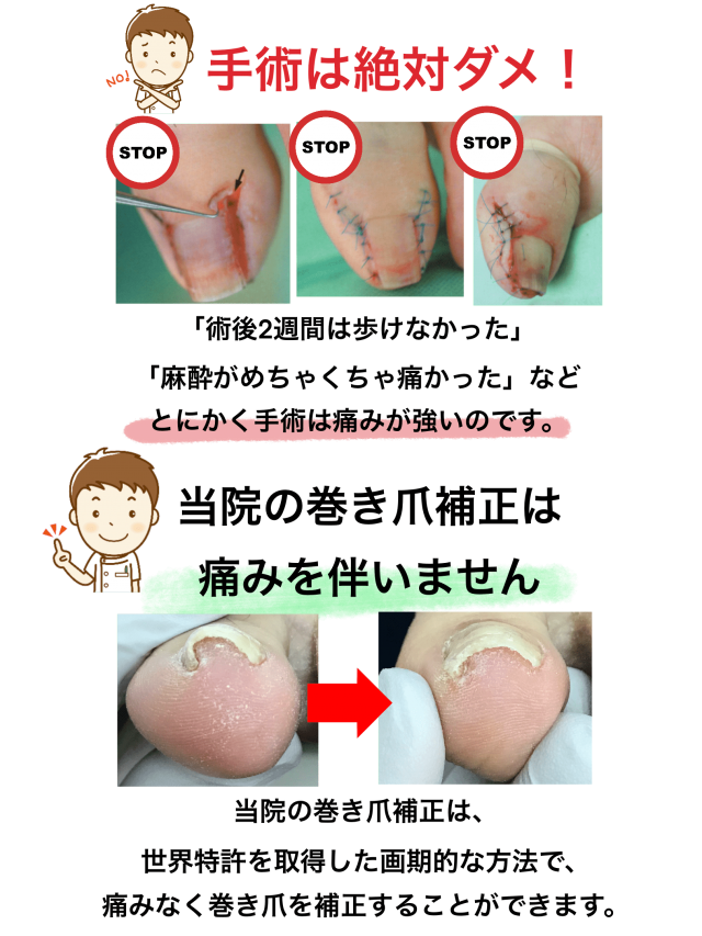 金沢市巻き爪手術しない