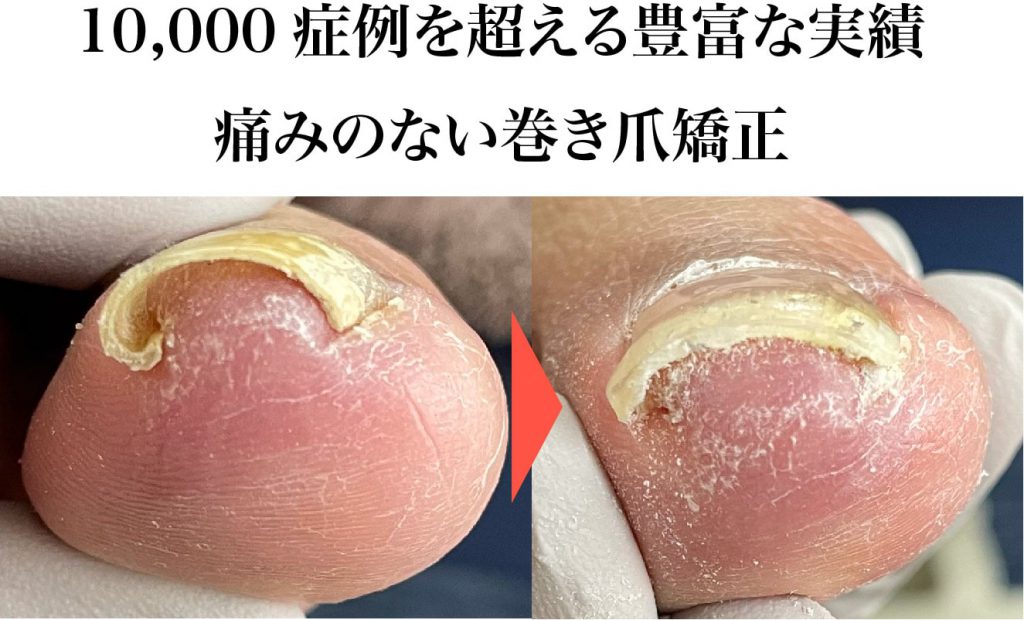 巻き爪矯正トップ画像