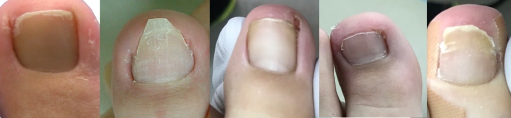 深爪治療金沢