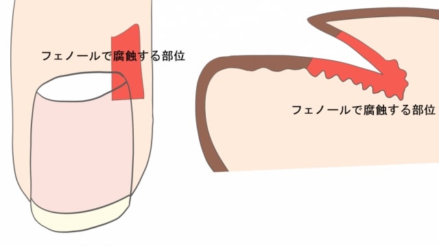 巻き爪手術フェノール法