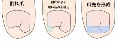 石川県金沢市巻き爪専門外来アルコットプラス割れ爪治療
