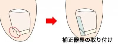石川県金沢市巻き爪専門外来アルコットプラス深爪の治療画像
