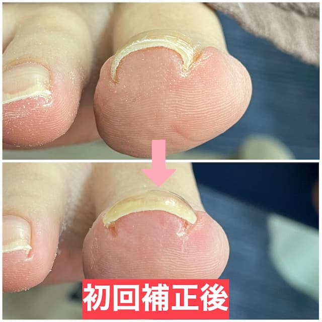 巻き爪補正効果金沢市