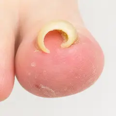 重度の巻き爪