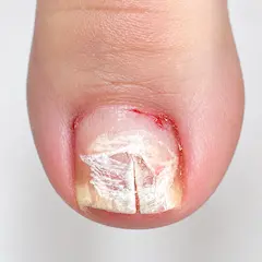 割れ爪