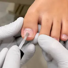 巻き爪メンテナンス