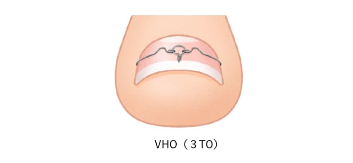 巻き爪治療VHO法（３TO法）