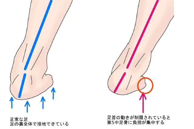 Jones骨折のリスク因子