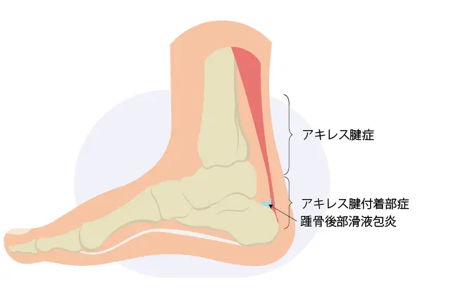 骨端症のメカニズム