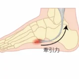 イズリン病 (Iselin病) とは？症状、原因、治療法を徹底解説