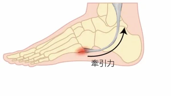 イズリン病 (Iselin病) とは？症状、原因、治療法を徹底解説