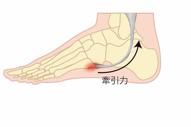 シーバー病の原因