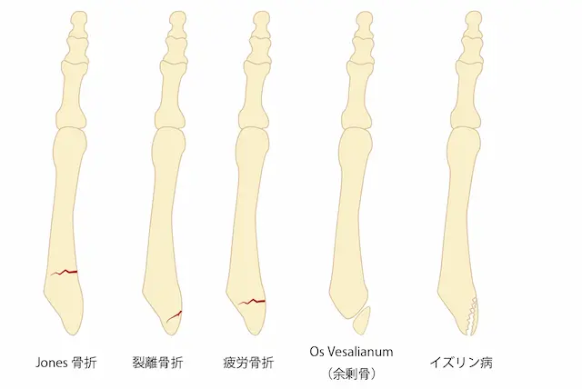 シーバー病のレントゲン