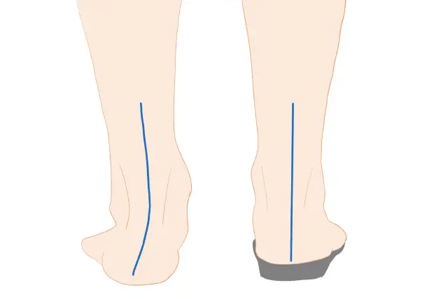 回内足を補正するインソール