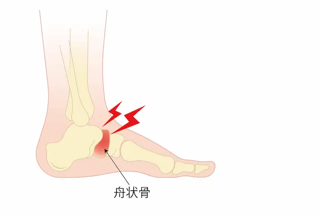 疲労骨折の原因