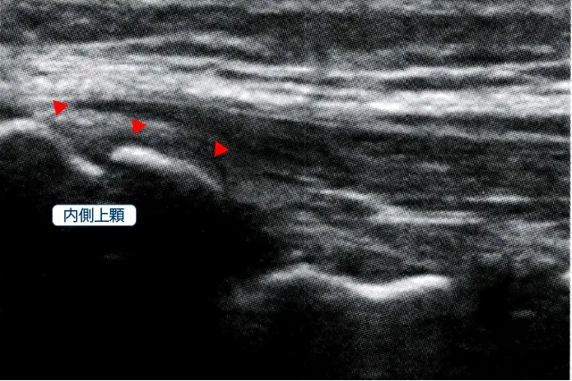 ゴルフ肘エコー画像