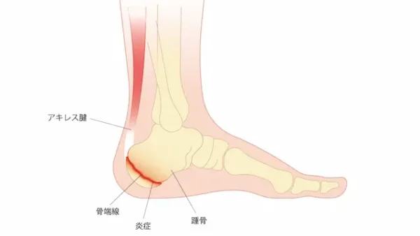 シーバー病 (Sever病) とは？成長期の踵の痛みの原因と治療法