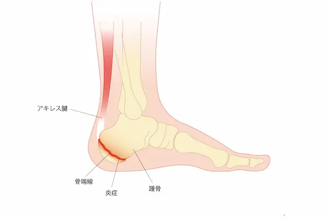 踵骨疲労骨折と足底腱膜炎の圧痛点の違い