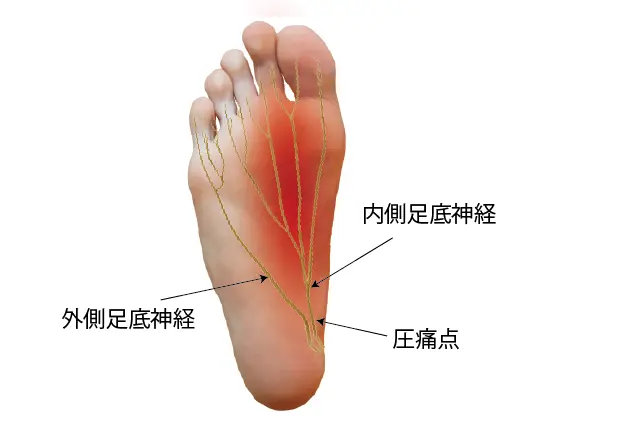 前足根管症候群のしびれの場所 (1)