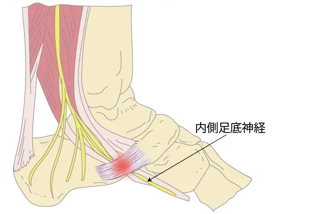 前足根管症候群症状