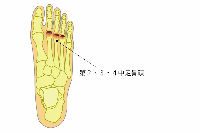 踵骨疲労骨折と足底腱膜炎の圧痛点の違い