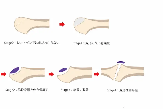 踵骨疲労骨折のメカニズム