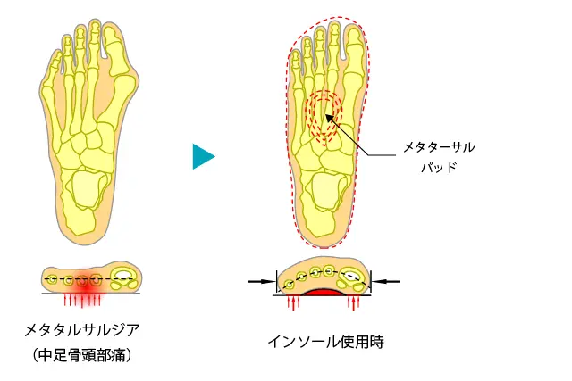 メタタルサルジア（中足骨頭部痛）に対するインソール