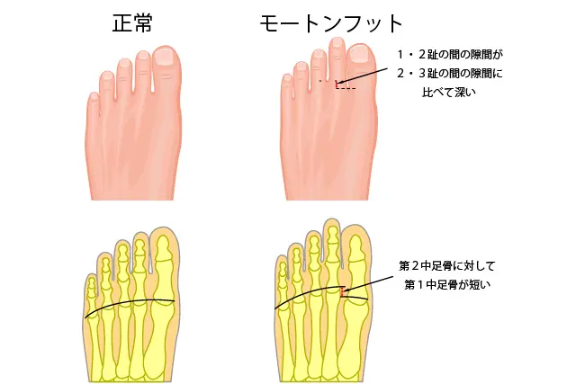 モートンフットとは