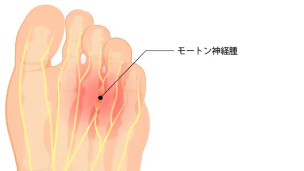 モートン病の痛みを解消！効果的な治療法と予防法を徹底解説