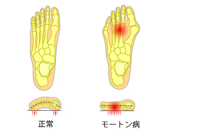 足のアーチの説明