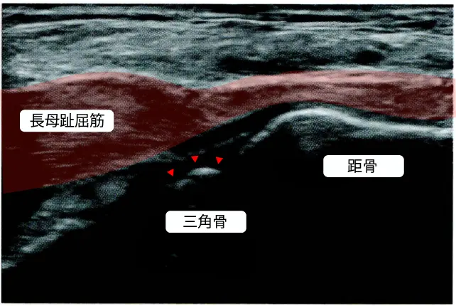 三角骨障害エコー