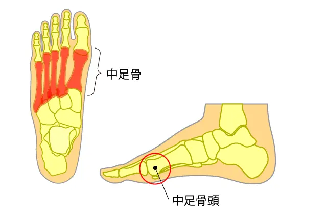 中足骨頭とは