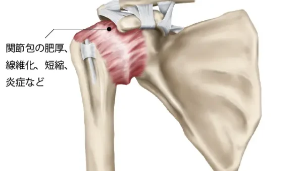 肩関節周囲炎・五十肩の原因や治療法【金沢市アルコット接骨院】