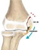 内側型野球肘の効果的な対策とリハビリ方法