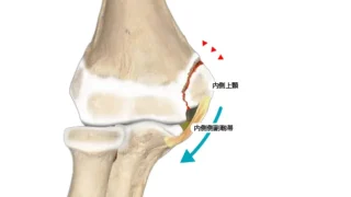 内側型野球肘の効果的な対策とリハビリ方法