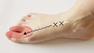 前足根管症候群とは？原因と治療法を詳しく解説