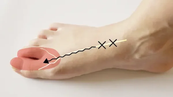 前足根管症候群とは？原因と治療法を詳しく解説
