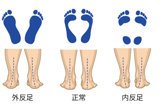 外反足と内反足