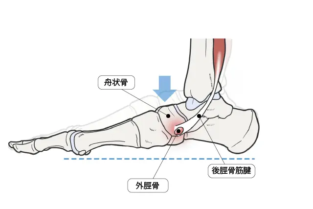 外脛骨の炎症が起こる場所