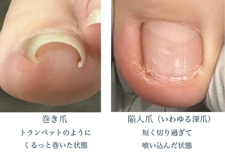 巻き爪と深爪の違い