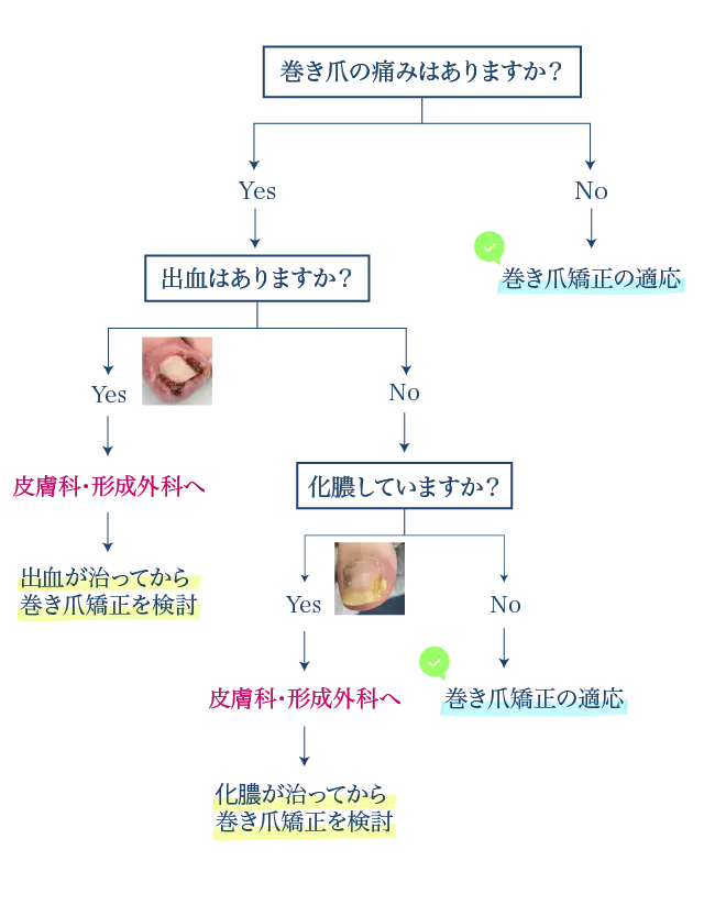 巻き爪のチャート