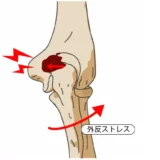 後方型野球肘の痛みを克服：効果的な治療法と予防策