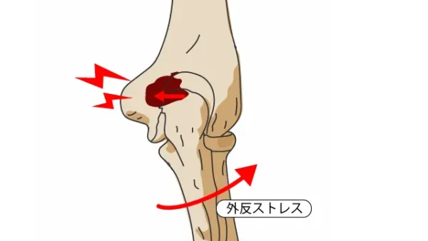 後方型野球肘の痛みを克服：効果的な治療法と予防策